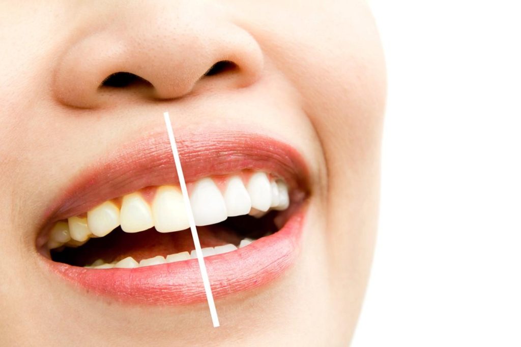 The Essential Guide To Teeth Cleaning: Achieving Optimal Oral Health