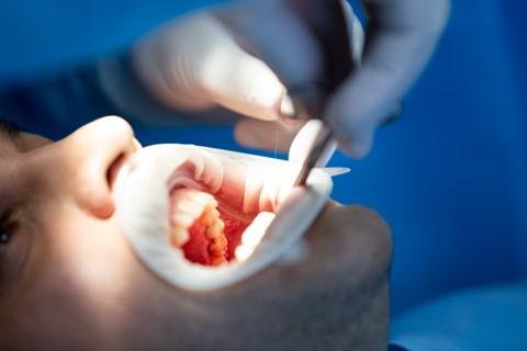 Understanding Wisdom Tooth Extraction: Procedure Recovery And Care