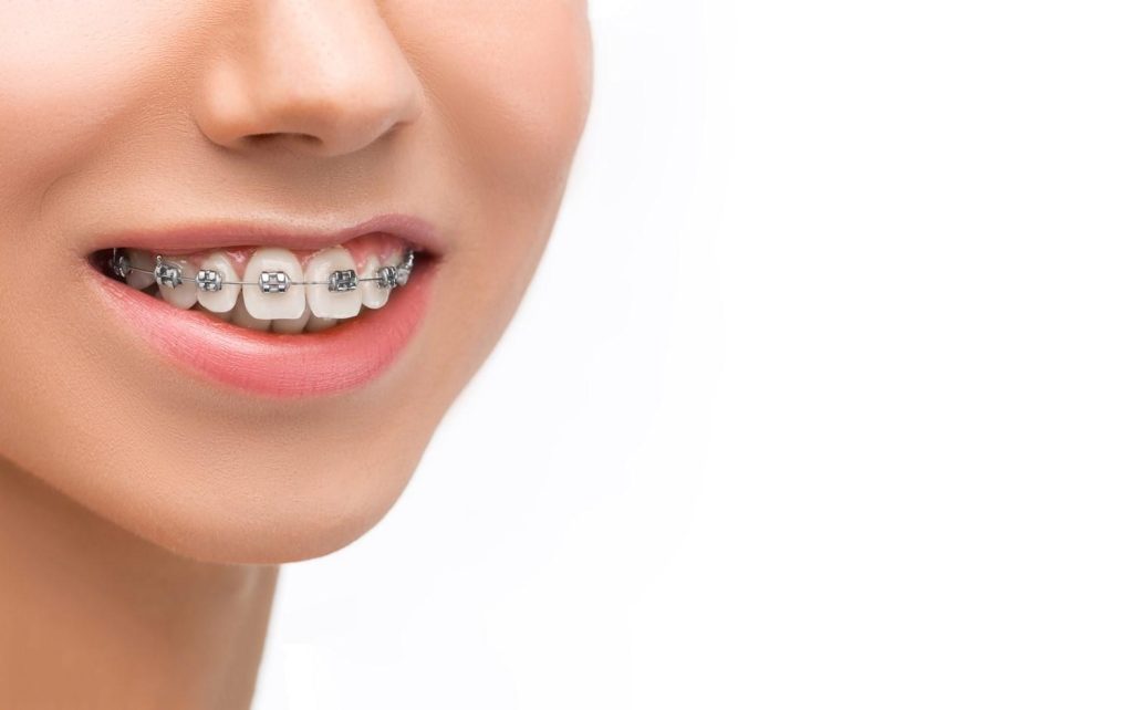 Embrace The Change: How Metal Braces Can Boost Your Confidence?