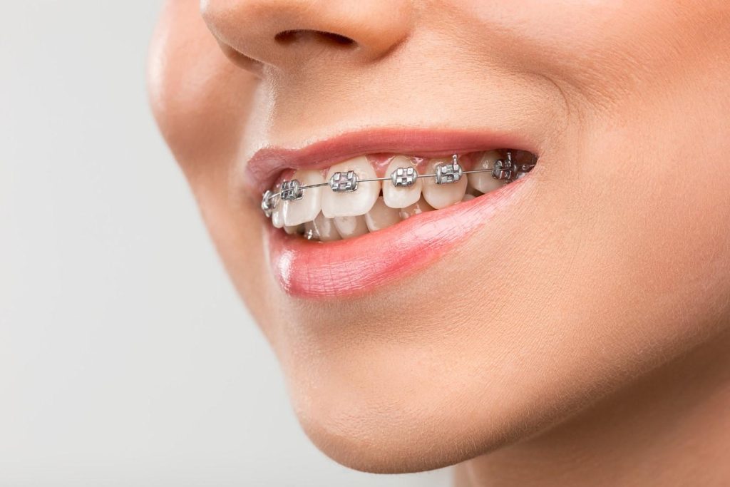 Metal Braces: A Comprehensive Guide To Straighten Your Smile