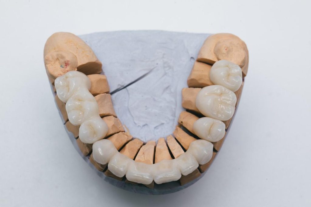 What Are Dental Bridges?